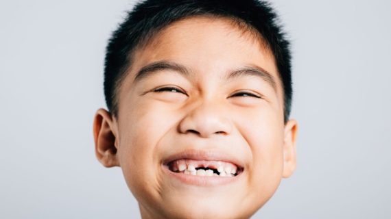 Gigi Anak Rusak? Ini Penyebab, Tips Perawatan, dan Rekomendasi Dokter Gigi Anak Terbaik