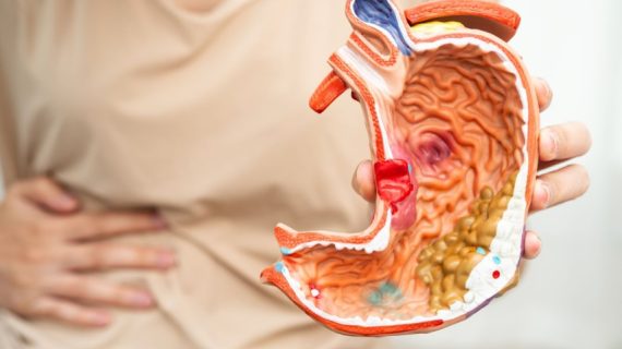 Jangan Abaikan Perut Sembelit, Bisa Jadi karena Ini!