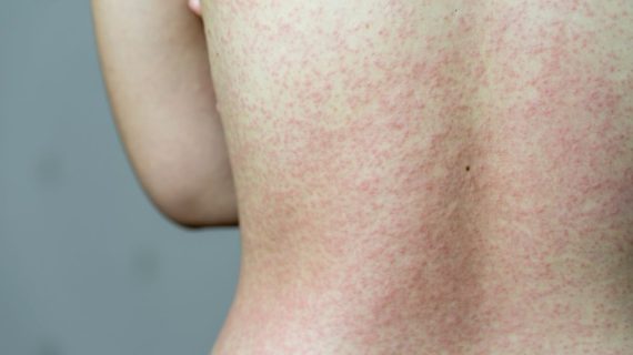 Waspada! Ini Bahaya Campak yang Terjadi pada Anak, Kapan Harus ke Dokter Anak Bandung?